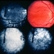 Macular Hypoplasia
